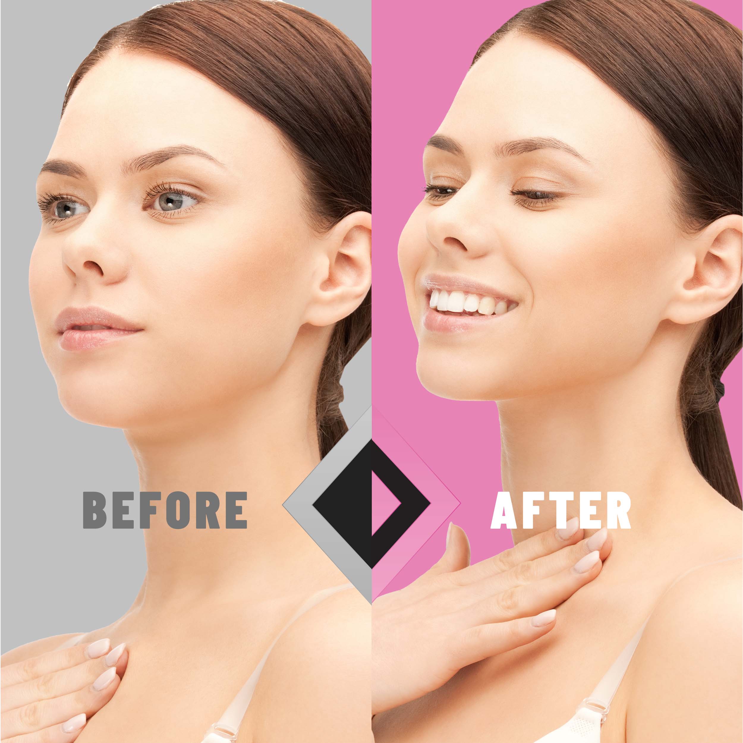 V-Line Lifting Mask, Double Chin Reducer with Hydrogel & Vitamin E, 5 masks - Image 3